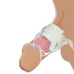 Dispositivo Para Incontinencia Urinaria Masculina Uropauher - Foto 4